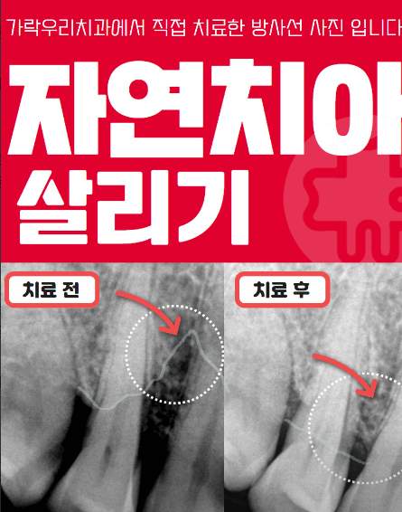 송파구 문정동 임플란트 치과